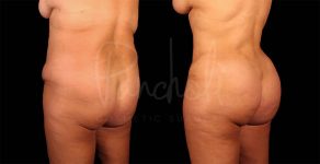 before and after Abdominoplasty, Liposuction and BBL back angle view female patient case 9330