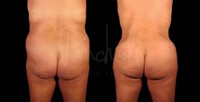 before and after Abdominoplasty, Liposuction and BBL back view female patient case 9330