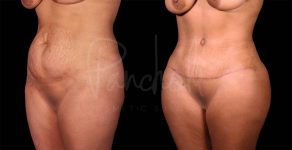 before and after Abdominoplasty with Lipo 360 and fat transfer to hips and buttocks front view female patient case 9336