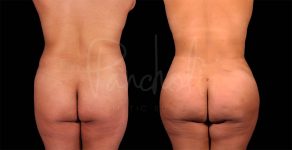before and after Abdominoplasty with Lipo 360 and fat transfer to hips and buttocks back view female patient case 9336