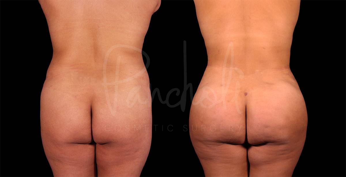 before and after Abdominoplasty with Lipo 360 and fat transfer to hips and buttocks back view female patient case 9336