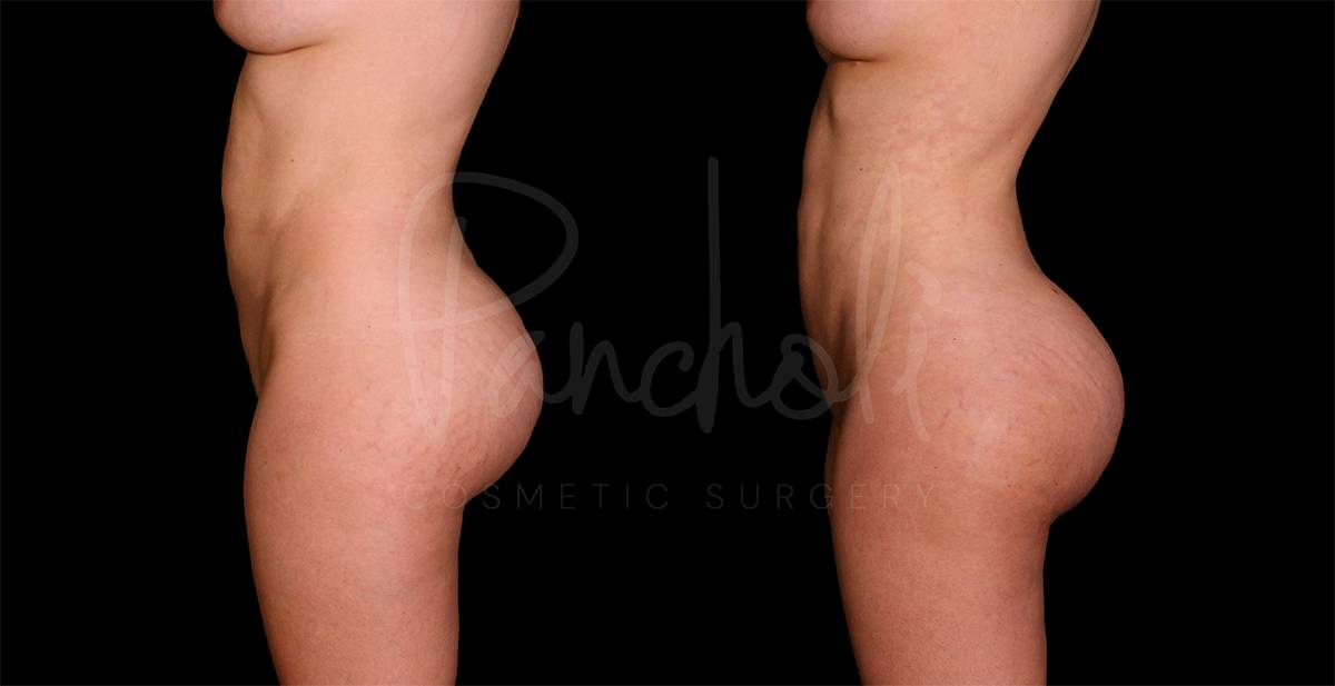 before and after Lipo with fat transfer to buttocks side view female patient case 9341
