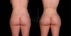 before and after Lipo with fat transfer to buttocks back view female patient case 9341