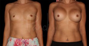 before and after breast augmentation front view female patient case 9284
