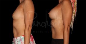 before and after breast augmentation side view female patient case 9284