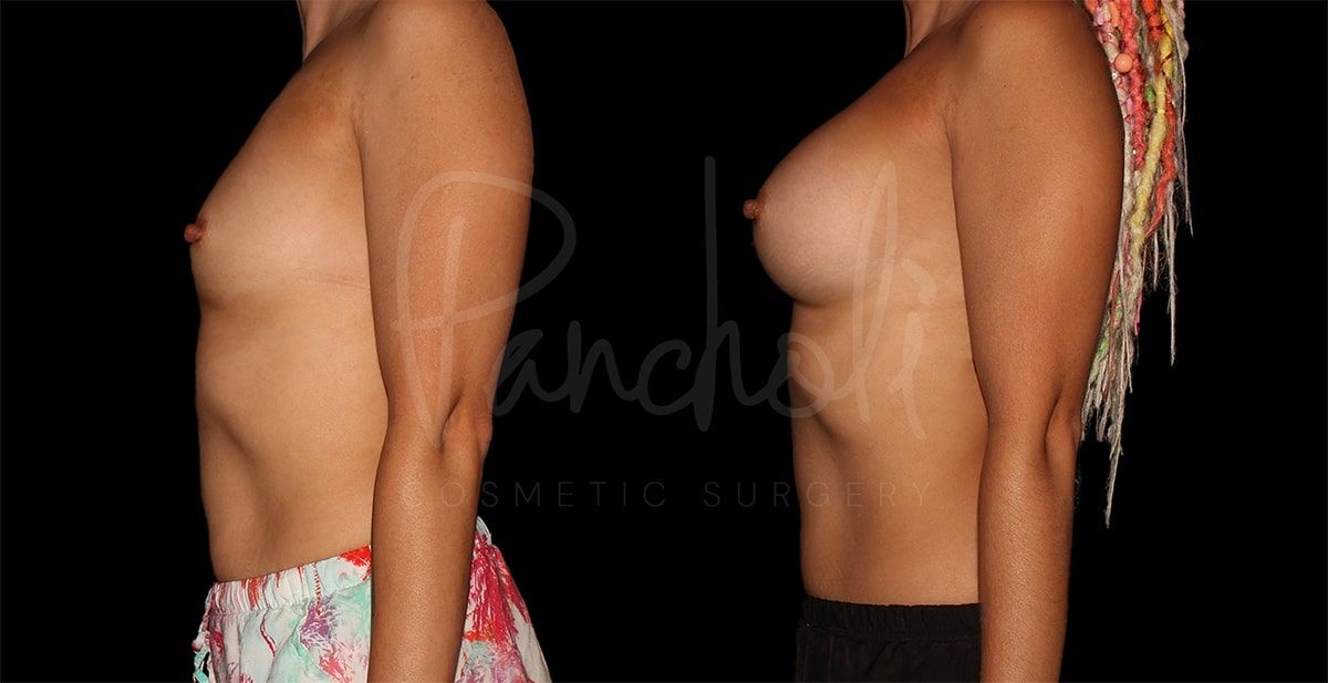before and after breast augmentation side view female patient case 9284