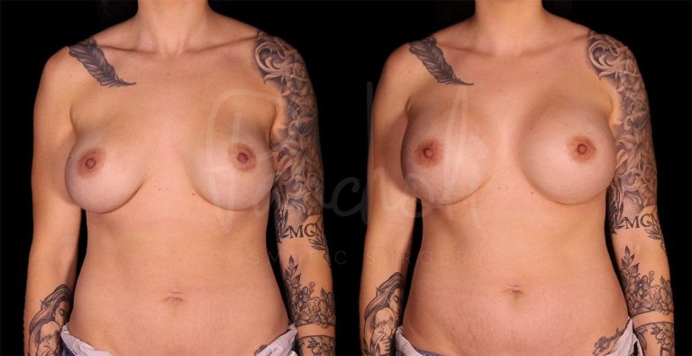 before and after breast implant replacement front view female patient case 9288
