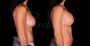 before and after breast implant replacement side view female patient case 9288