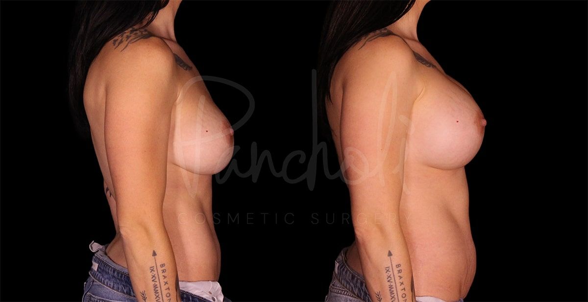 before and after breast implant replacement side view female patient case 9288