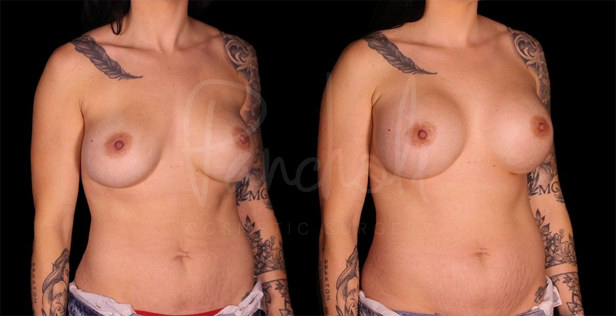 before and after breast implant replacement front angle view female patient case 9288
