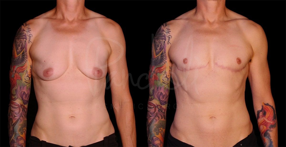 before and after female to male masculization front view case 9280