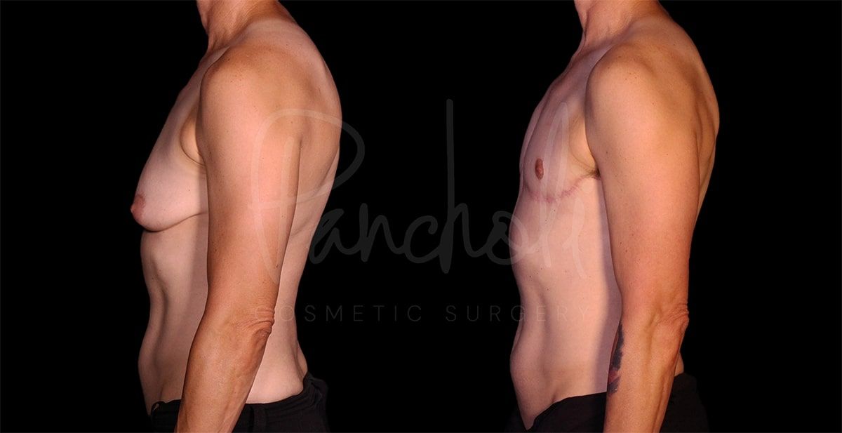 before and after female to male masculization side view case 9280