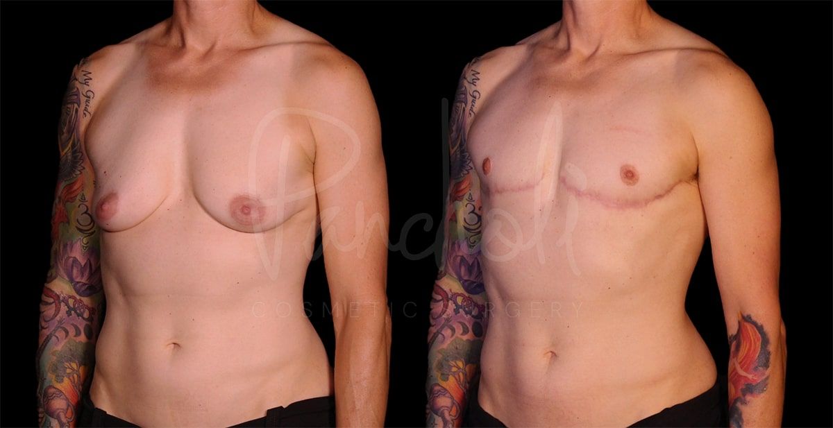 before and after female to male masculization angle view case 9280