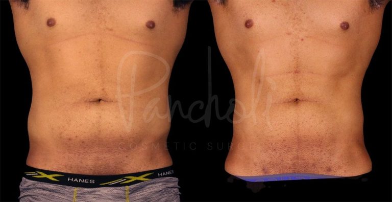 before and after vaser liposuction abdomen front view male patient case 9274