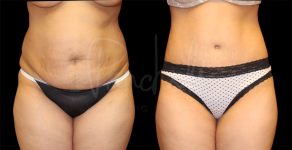before and after tummy tuck front view female patient case 9292