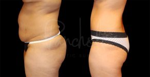 before and after tummy tuck side view female patient case 9292
