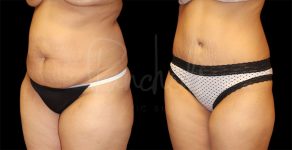 before and after tummy tuck front angle view female patient case 9292