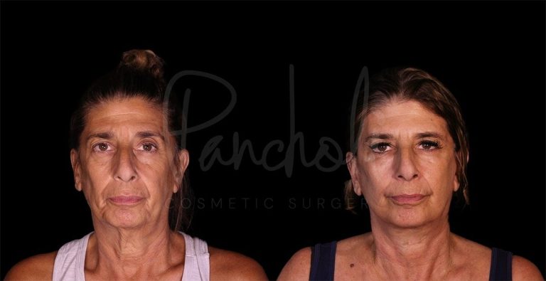 before and after facelift female patient front view case 9645